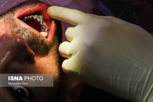 شیوع بی دندانی در ایران بعد از ۳۵ سالگی