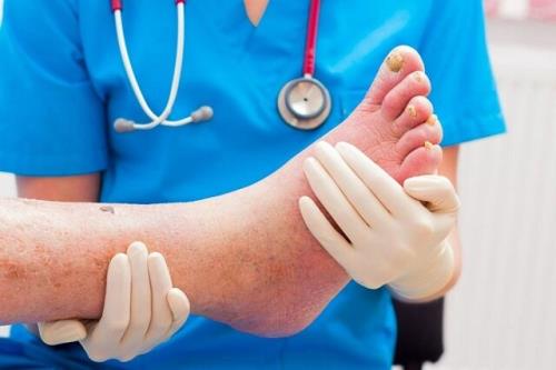 چگونه از عارضه پای دیابتی پیشگیری کنیم؟