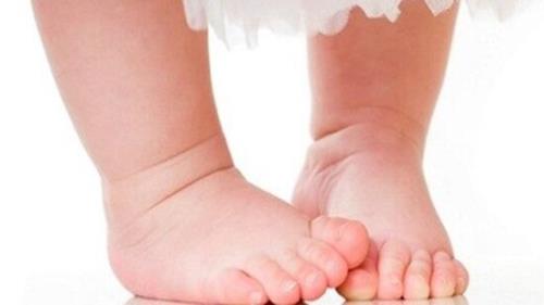 شایع ترین علت پای پرانتزی در کودکان