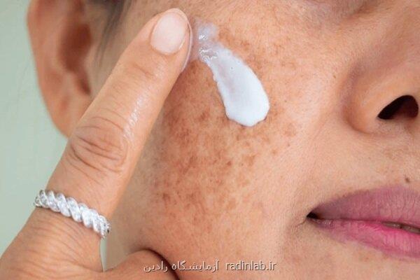 اخطار مراقب سوختگی های پنهان آفتاب باشید