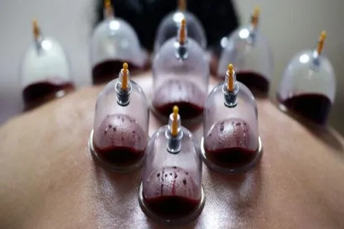 حجامت توسط افراد غیر متخصص خطرآفرین است