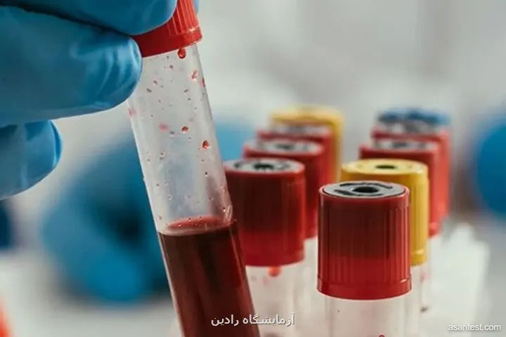 پیش بینی خطر عود سرطان خون با آزمایش ژنتیک