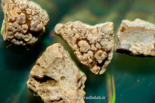 از بین بردن سنگ كلیه با كمك امواج فراصوت